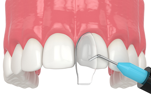 Performing cosmetic bonding on upper teeth