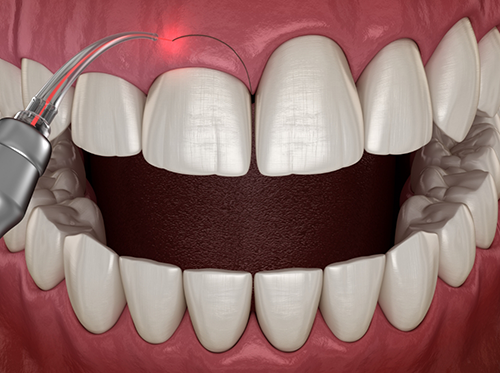 Illustration of gum recontouring performed with dental laser