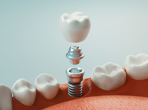 Illustration of crown, abutment, and dental implant being placed in jaw