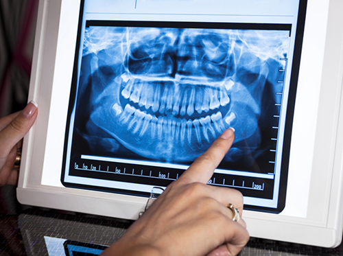 Pointing to X ray of the teeth