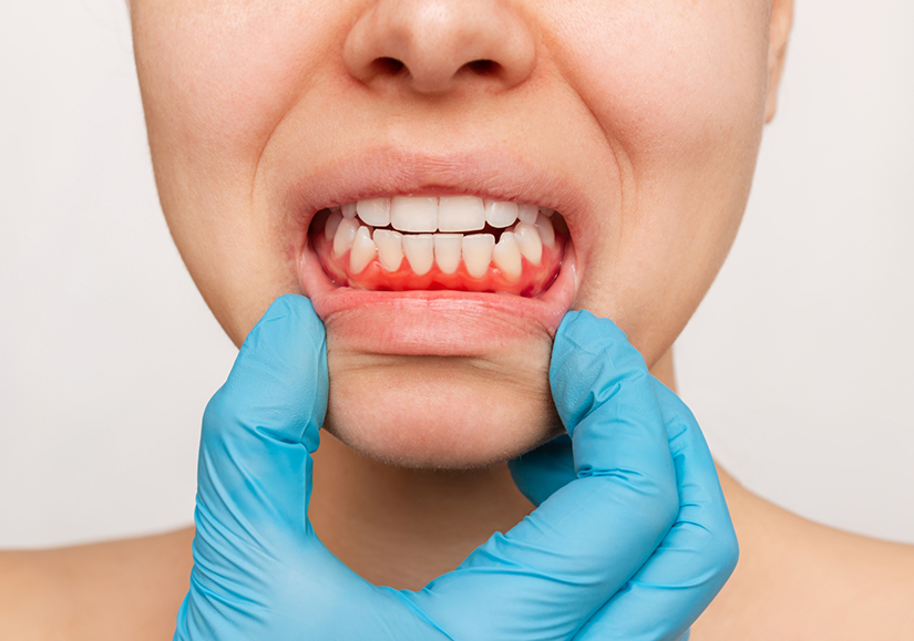 Pulling down lip to show inflamed gums needing gum disease treatment in Delray Beach