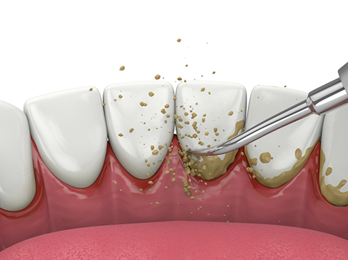 Illustration of scaling and root planing being performed on back of teeth