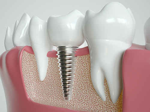 Model of a dental implant between natural teeth