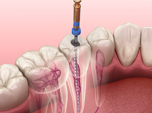 Illustration of root canal treatment in Delray Beach for tooth in lower arch