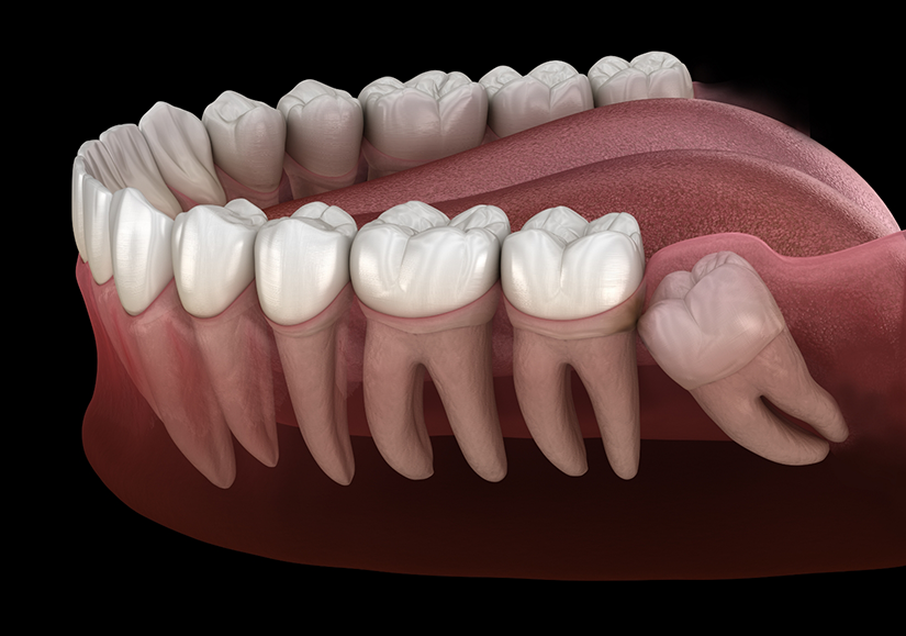 Illustration of impacted wisdom tooth in Delray Beach